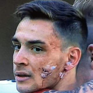 De Sciglio Infortunio