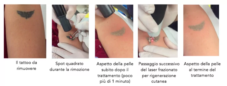 Sequenza rimozione tattoo e rigenerazione