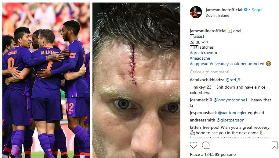 James Milner 15 punti di sutura scontro Mario Rui