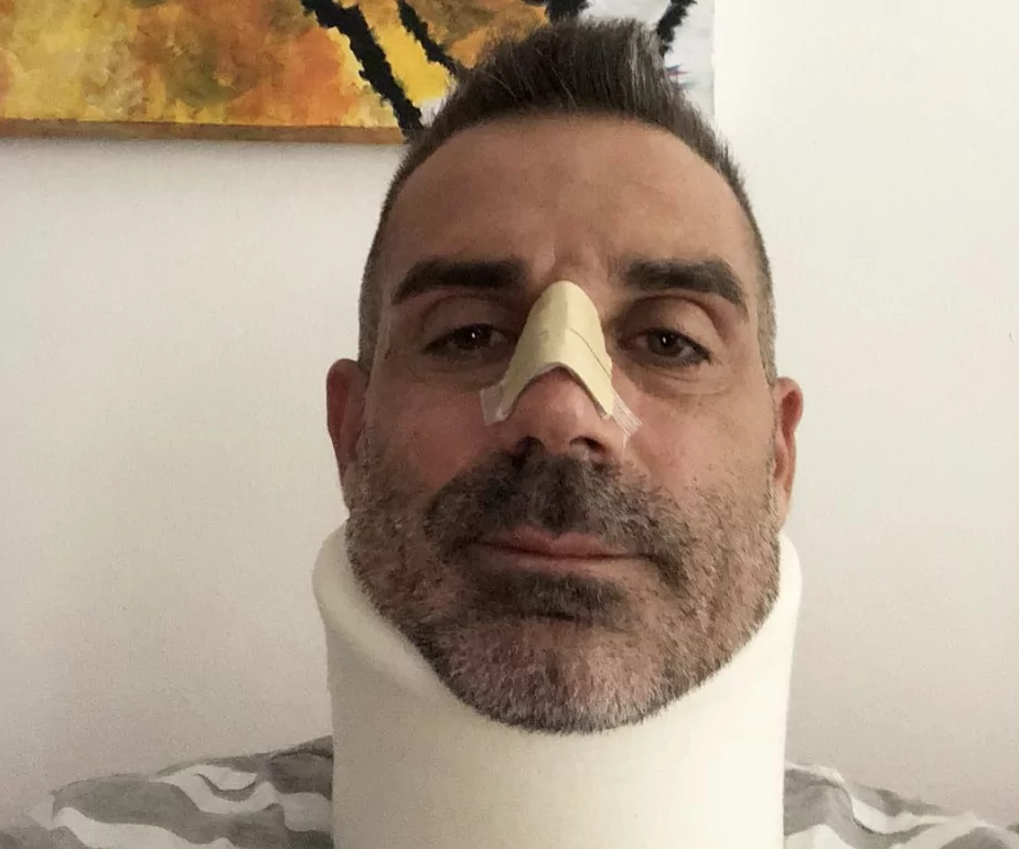 sorrentino frattura naso