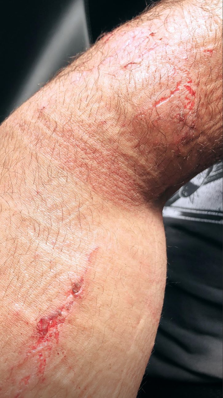 Infortunio Seth Rollins RAW Sangue braccio