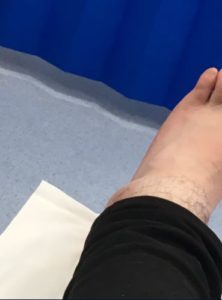 piede tifoso caviglia rotta