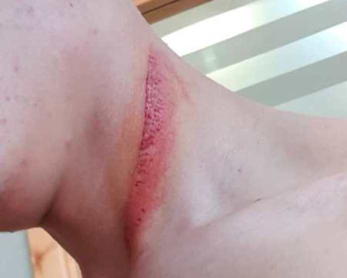 taglio sul collo oncu moto3